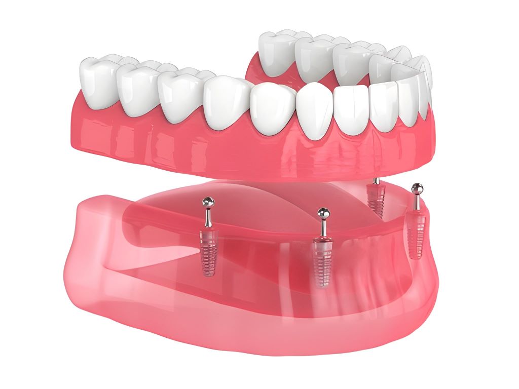 implant supported denture in etobicoke, on