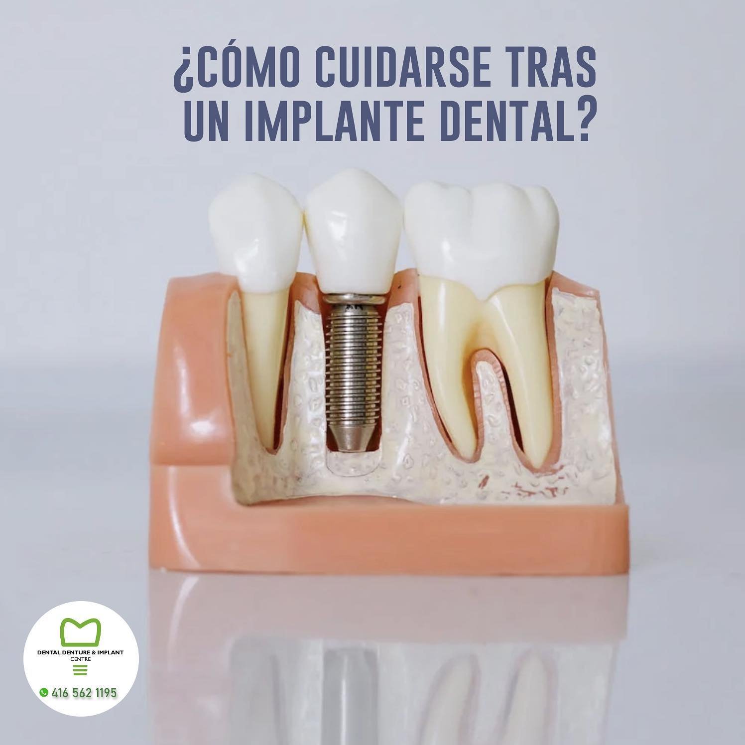 implant post