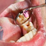 Benefits of Composite Fillings