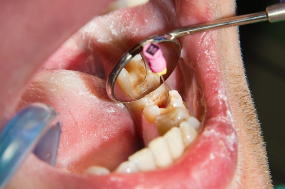 Benefits of Composite Fillings